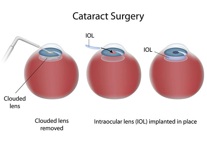 Chart illustrating the cataract surgery process