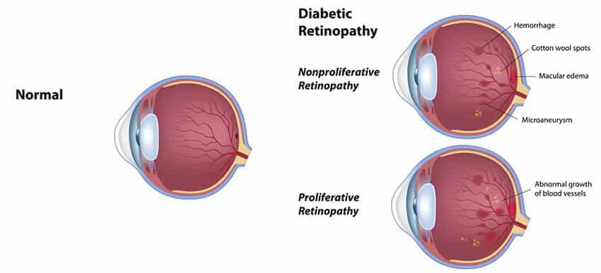 Chart illustrating a normal eye compared to one going through diabetic retinopathy