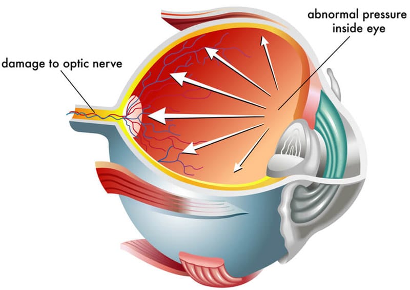 Chart illustrating how glaucoma affects an eye