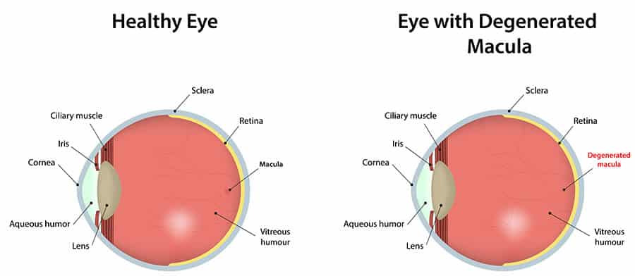 Chart illustrating a healthy eye vs one with a degenerated macula